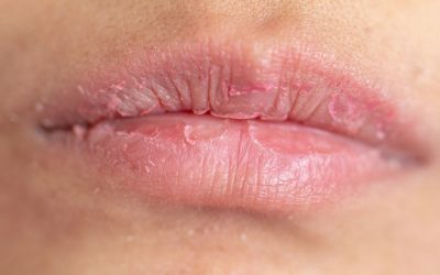 Follow These Steps to Prevent Dry Chapped Lips